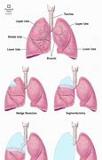 Image result for Wedge Resection Lung Surgery
