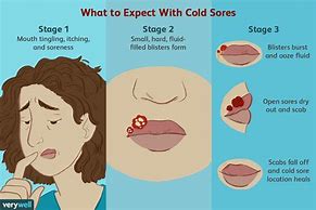 Image result for Stress Cold Sore