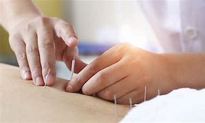 Image result for Acupuncture Back Pain