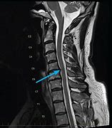 Image result for MRI Cervical Spine Lesions