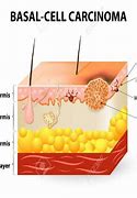 Image result for Basal Cell Carcinoma Diagram