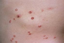 Image result for Molluscum Contagiosum Early Stage
