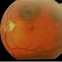 Image result for Choroidea Eye
