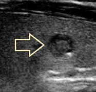 Image result for Punctate Echogenic Foci Thyroid