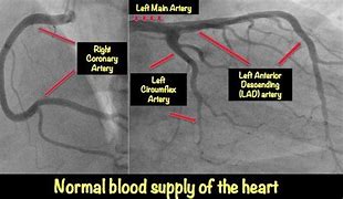 Image result for Blocked Coronary Artery Angiogram