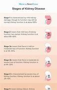 Image result for Acute Renal Failure Stages
