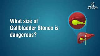 Image result for 2 Cm Stone