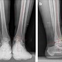 Image result for Paragon 28 Calcaneal Osteotomy