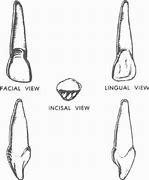 Image result for Upper Right Lateral Incisor