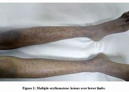 Image result for Fifth Disease Rash On Feet