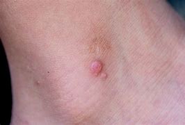 Image result for Molluscum Contagiosum On Finger