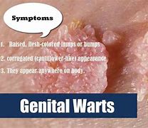 Image result for venereal warts signs