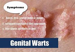 Image result for Genital Warts in Men Disease