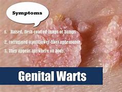 Image result for Genital Warts On Thigh