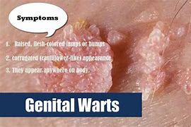 Image result for Mild Genital Warts