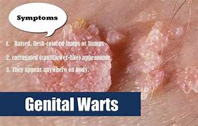 Image result for +Genitals Wart Pictures Early Stage