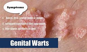 Image result for Genital Warts Types