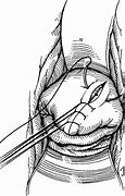 Image result for Genital Wart Removal Surgery