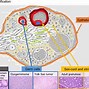Image result for Tumors On Ovaries