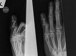 Image result for Dislocated Finger X-ray