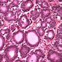 Image result for Pancreatic Acinar Cell Carcinoma