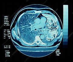 Image result for Small Cell Lung Cancer Chest X-Ray