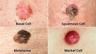 Image result for Types of Skin Cancer Cells