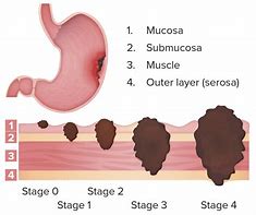Image result for Stomach Cancer Tumor Size