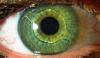 Image result for Implanted Lenses