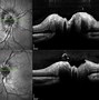Image result for Papilledema Optic Nerve Oct