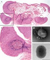 Image result for Molluscum Contagiosum Virus Morphology