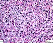 Image result for Appendiceal Carcinoid