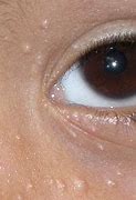 Image result for Molluscum Contagiosum Toddler