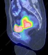 Image result for Pet Scan Cervical Cancer