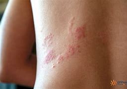 Image result for Shingles Scabs