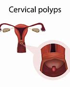 Image result for Endometrial Cervical Polyp