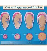 Image result for 2 Cm Dilated Induction