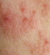 Image result for Raised Itchy Rash On Body