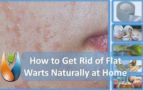 Image result for Home Remedies for Flat Warts