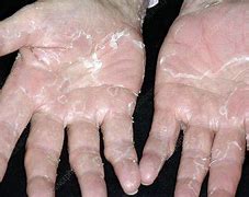 Image result for Loose Skin On Hands