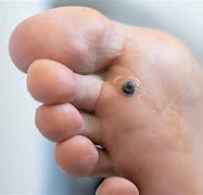 Image result for HPV Foot Wart