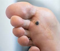 Image result for Plantar Wart Pictures On Feet