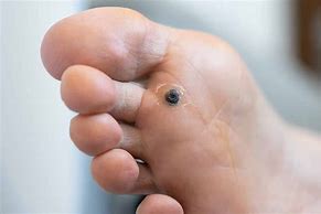 Image result for Wart On Side of Foot