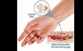 Image result for What Does the First Stage of Scabies Look Like