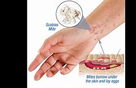 Image result for Scabies On Wrist