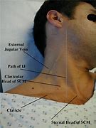Image result for How to Assess for Jvd