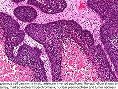 Image result for High Grade Dysplasia in Sinonasal Papilloma