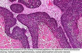 Image result for Sinonasal Papilloma Inverted Type Gross