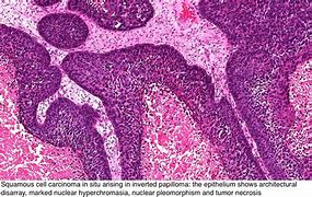 Image result for Sinonasal Papilloma