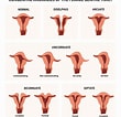Image result for Uterus Didelphys. Size: 110 x 106. Source: www.mfmnyc.com